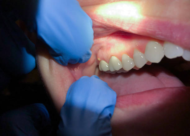 Best Emergency Dentist for Lost Fillings or Crowns in Lockport, LA
